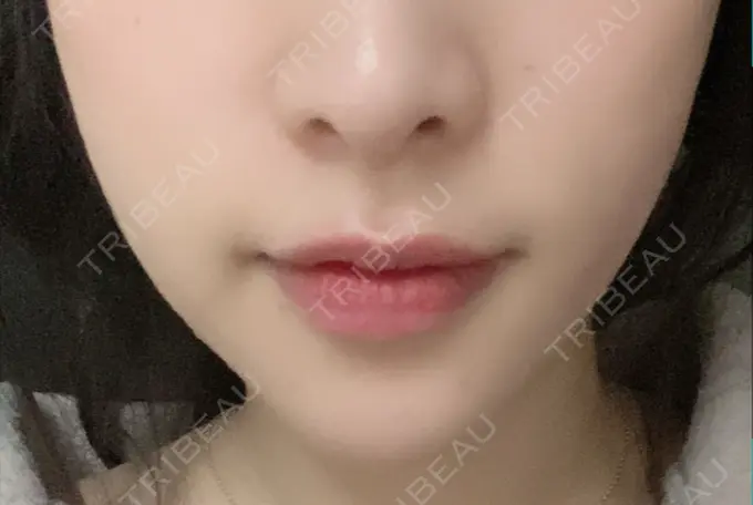 あごプロテーゼ / 骨切り（あご） / 脂肪吸引（顔） 心斎橋コムロ美容外科クリニック DAY 99 メイン用