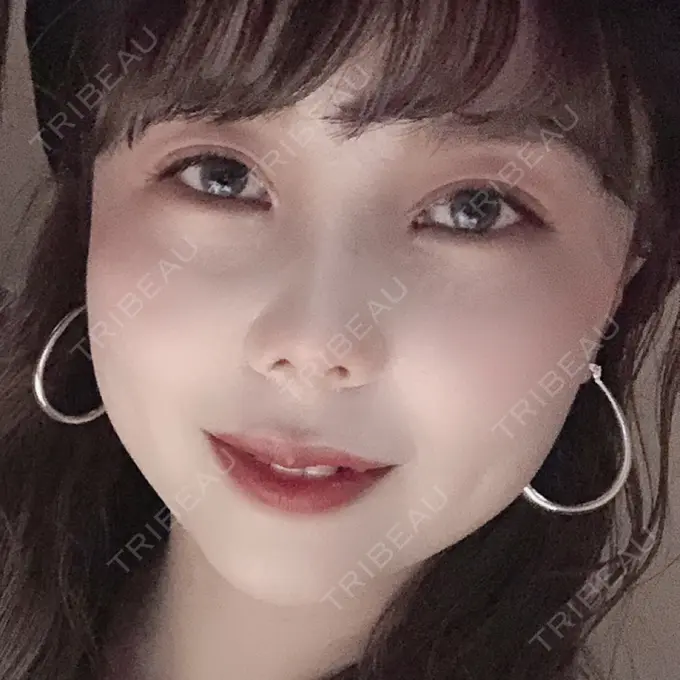 二重埋没 / 目頭切開 ドクター松井クリニック 新宿 DAY 17 メイン用