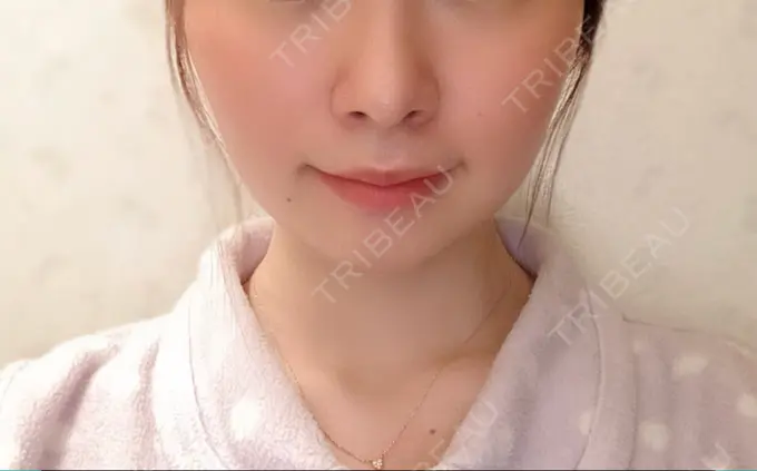 脂肪溶解注射（顔） 赤坂プレミアクリニック AFTER メイン用