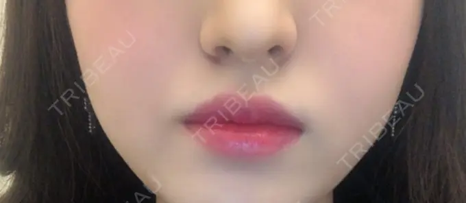 ヒアルロン酸注入（唇） / ボトックス（口角） TCB東京中央美容外科 堺院 DAY 28 メイン用