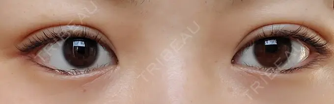 二重埋没 城本クリニック 名古屋院 AFTER メイン用