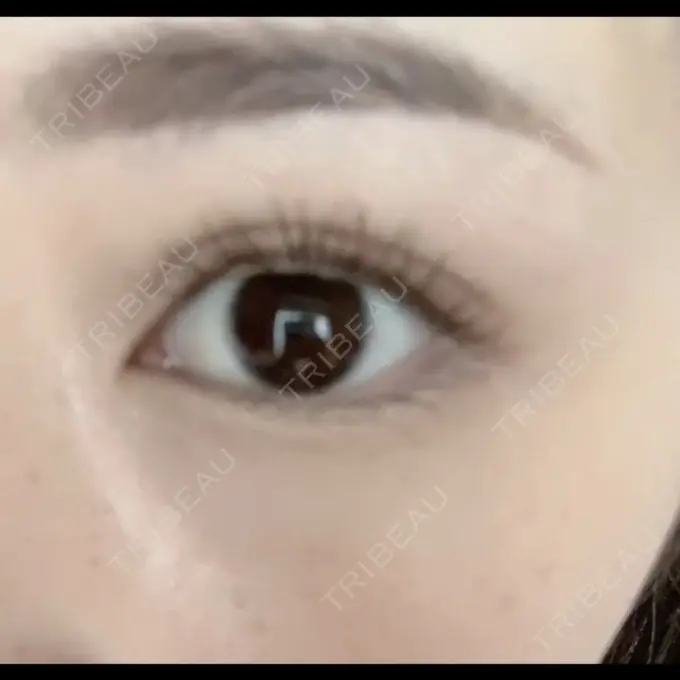 二重埋没 / 上まぶたの脂肪取り / 自然癒着法 FROM B整形外科 (旧バウム整形外科) AFTER メイン用