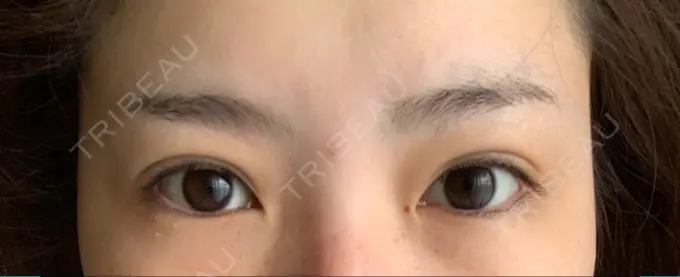 二重埋没 / 上まぶたの脂肪取り / 自然癒着法 FROM B整形外科 (旧バウム整形外科) DAY 170 メイン用