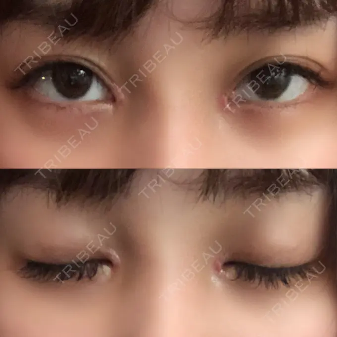 二重埋没 / 目頭切開 ドクター松井クリニック 新宿 DAY 19 メイン用