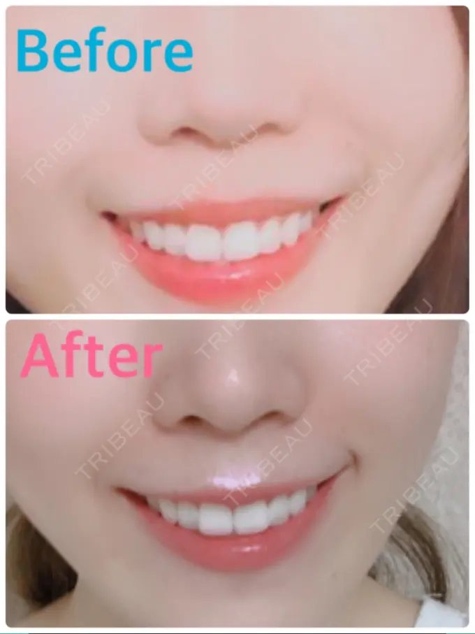 シワ取りボトックス / その他（鼻） もとび美容外科クリニック 新宿院 AFTER メイン用