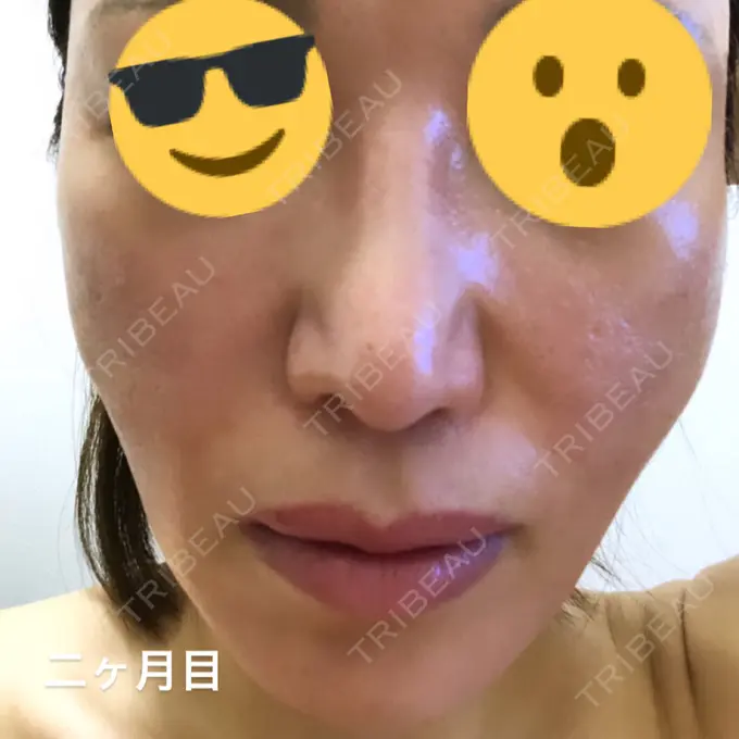 その他（目元） スノウ（Snow）整形外科 DAY 59 メイン用