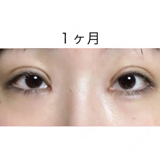 二重切開 / 目頭切開 / 眼瞼下垂（切開） / 目尻切開 / タレ目形成・グラマラスライン（切開） ジュエリー美容外科 DAY 31 メイン用