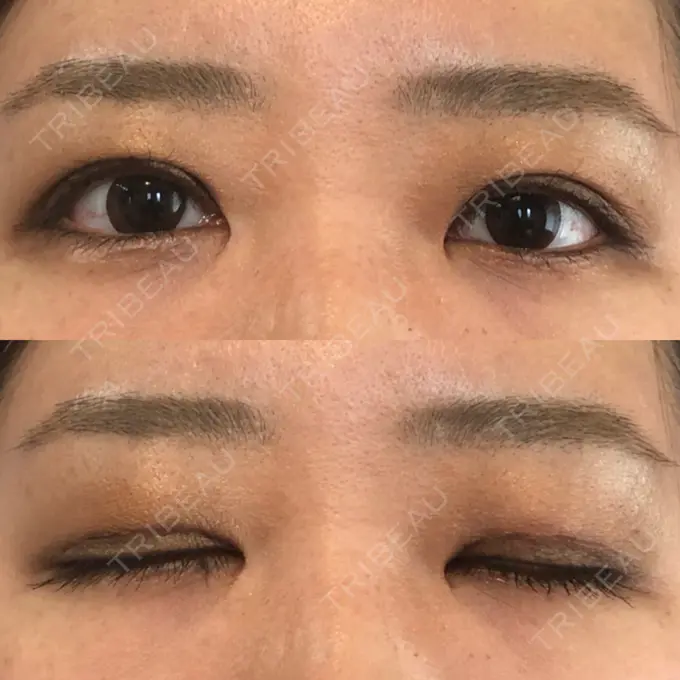 二重切開 / 目頭切開 / その他（目元） 新前橋かしま眼科形成外科クリニック DAY 25 メイン用