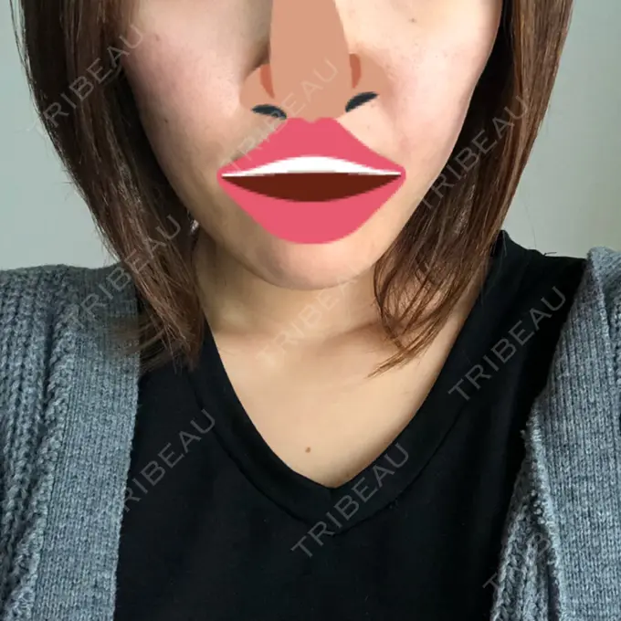 脂肪吸引（顔） アサミ美容外科 渋谷院 DAY 37 メイン用