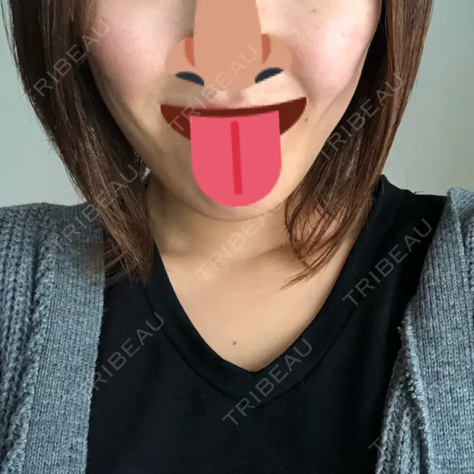 脂肪吸引（顔） アサミ美容外科 渋谷院 DAY 37 メイン用