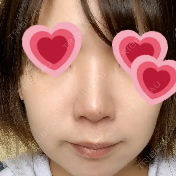 鼻尖形成（切開） / 小鼻縮小（切開） / 軟骨移植 もとび美容外科クリニック 新宿院 AFTER メイン用