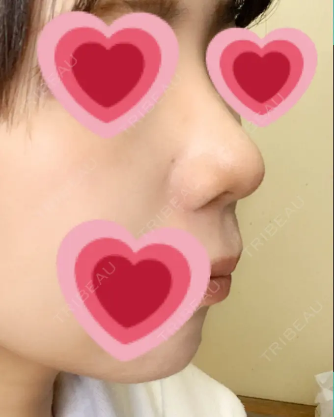 鼻尖形成（切開） / 小鼻縮小（切開） / 軟骨移植 もとび美容外科クリニック 新宿院 DAY 329 メイン用