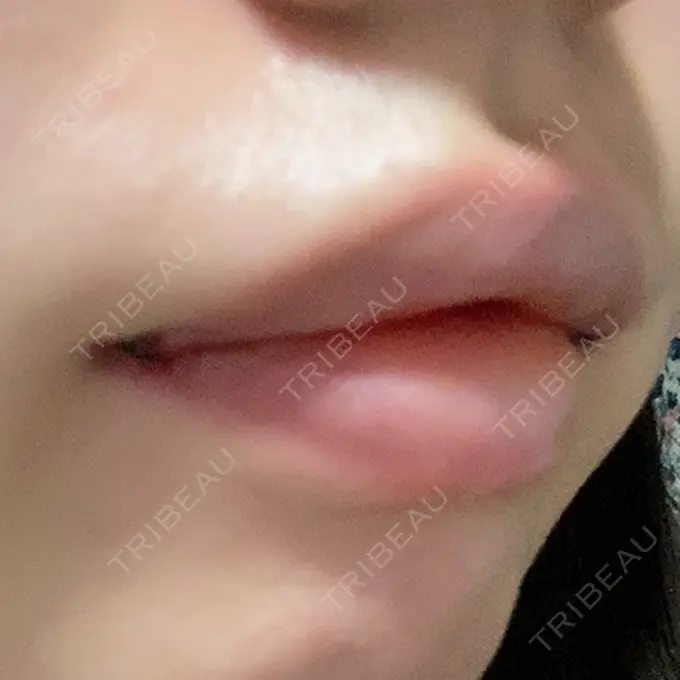 口角挙上 聖心美容クリニック 六本木院 DAY 1 メイン用