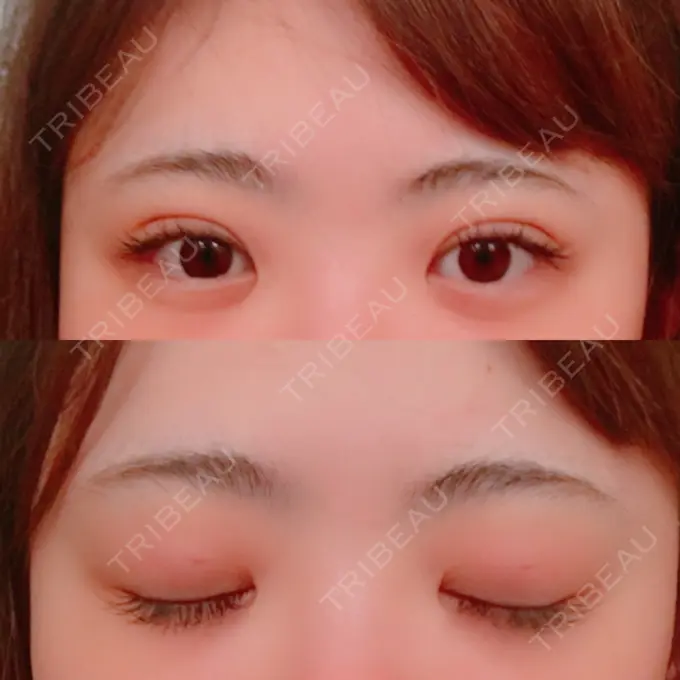 二重埋没 共立美容外科 柏院 DAY 0 メイン用