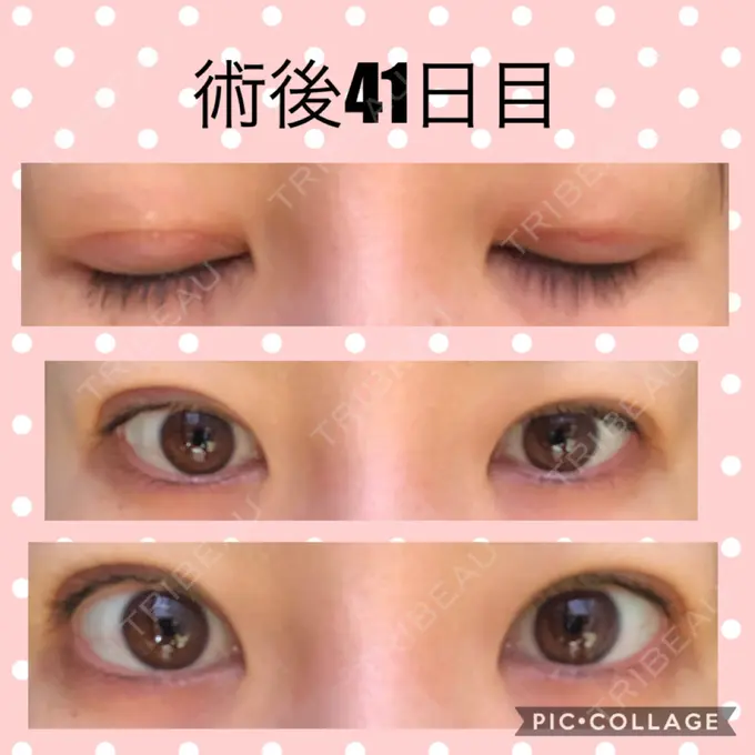 二重切開 マリアクリニック 安城院 DAY 41 メイン用