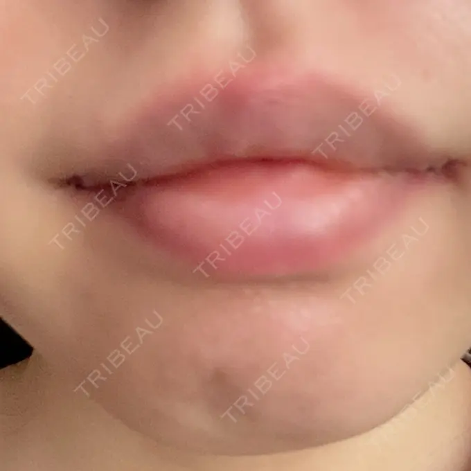 口角挙上 聖心美容クリニック 六本木院 DAY 2 メイン用