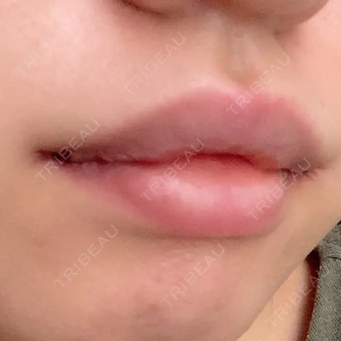 口角挙上 聖心美容クリニック 六本木院 DAY 2 メイン用