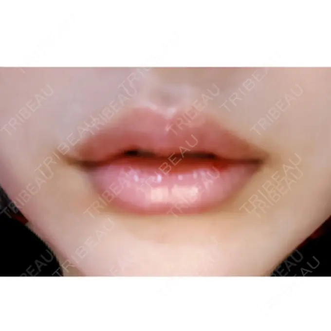 口唇縮小術 ビスポーククリニック 福岡院 DAY 8 メイン用