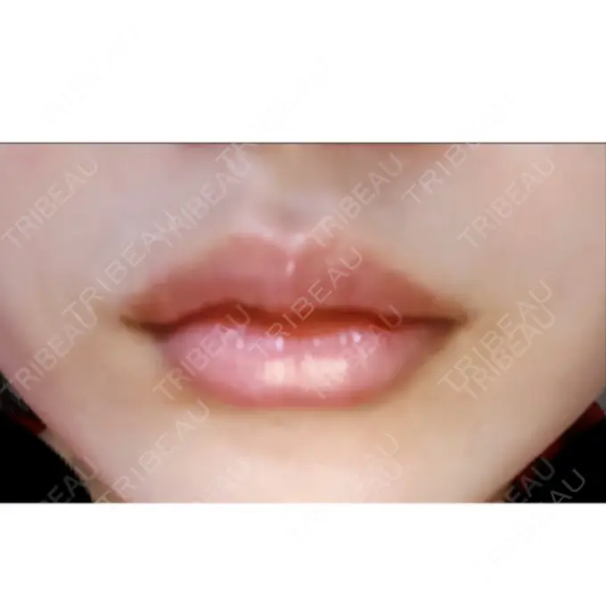 口唇縮小術 ビスポーククリニック 福岡院 DAY 8 メイン用