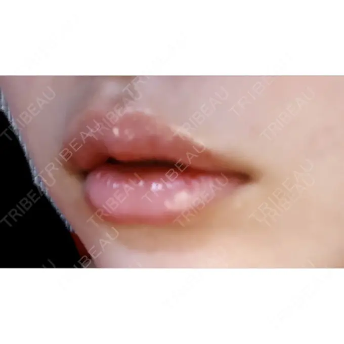 口唇縮小術 ビスポーククリニック 福岡院 DAY 8 メイン用