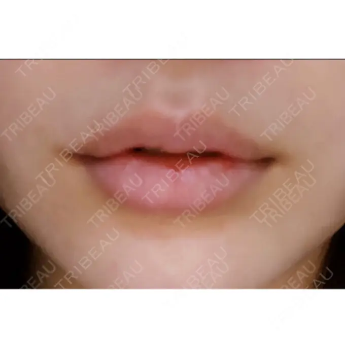 口唇縮小術 ビスポーククリニック 福岡院 DAY 9 メイン用