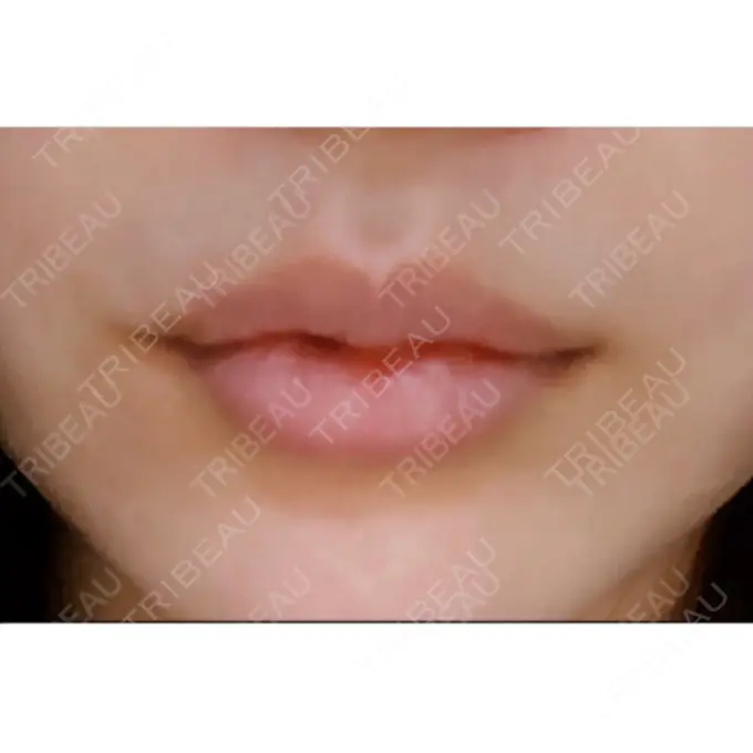 口唇縮小術 ビスポーククリニック 福岡院 DAY 9 メイン用