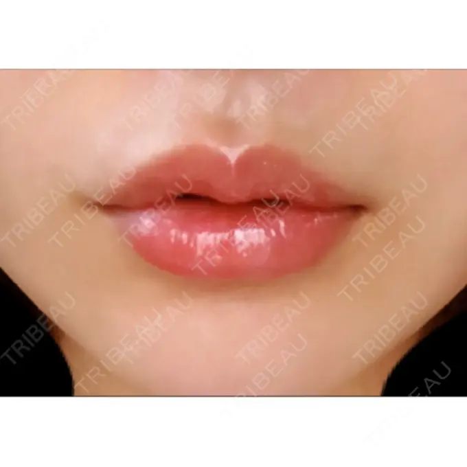 口唇縮小術 ビスポーククリニック 福岡院 AFTER メイン用