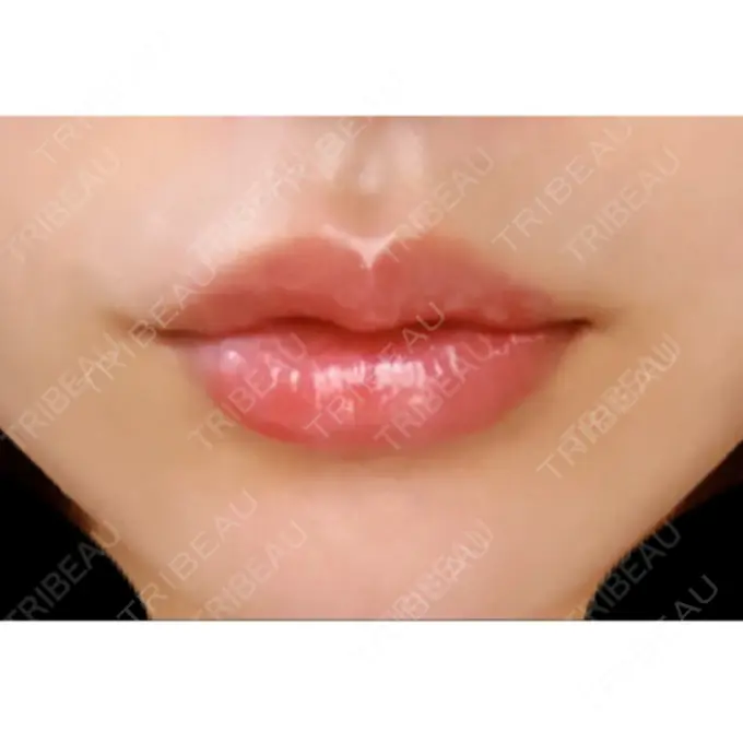 口唇縮小術 ビスポーククリニック 福岡院 DAY 10 メイン用