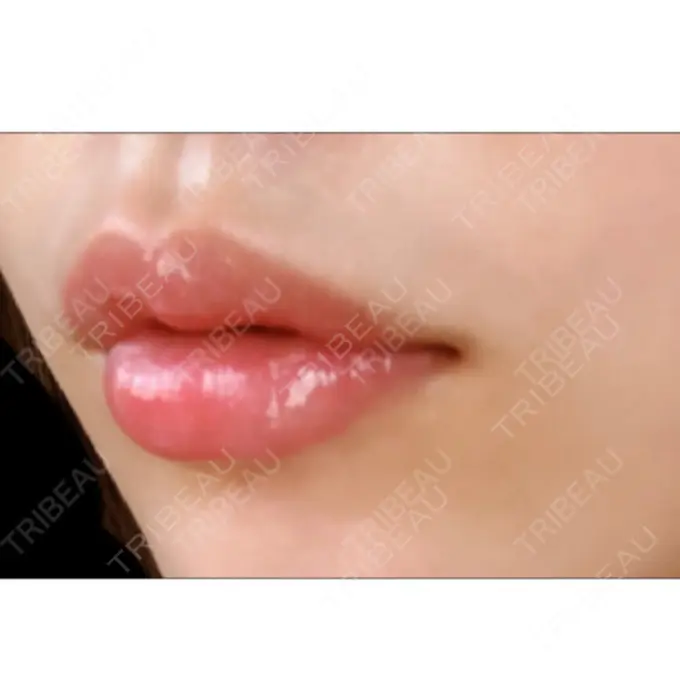 口唇縮小術 ビスポーククリニック 福岡院 DAY 10 メイン用