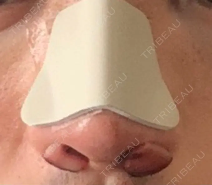 鼻尖形成（切開） / 軟骨移植 / レディエッセ注入（鼻） LETICIA CLINIC（レティシア クリニック） DAY 1 メイン用