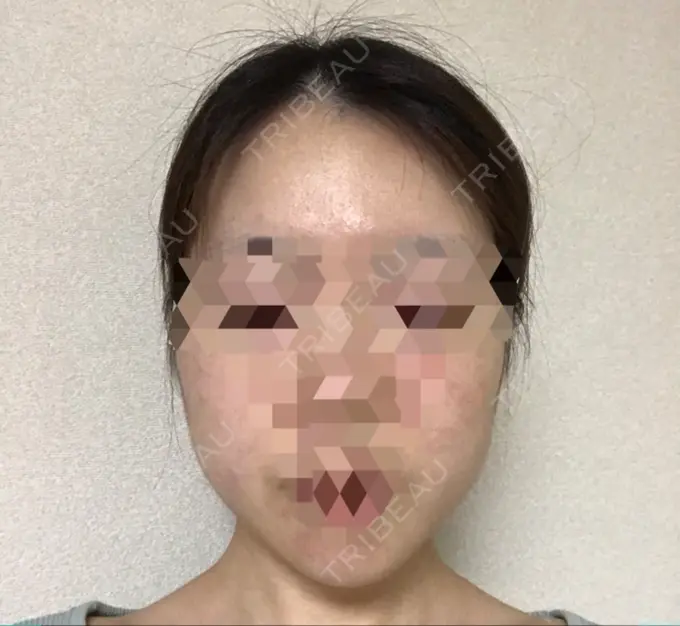 糸リフト / 骨切り（あご） / 骨削り（エラ） RG整形外科（旧リオン整形外科） DAY 66 メイン用