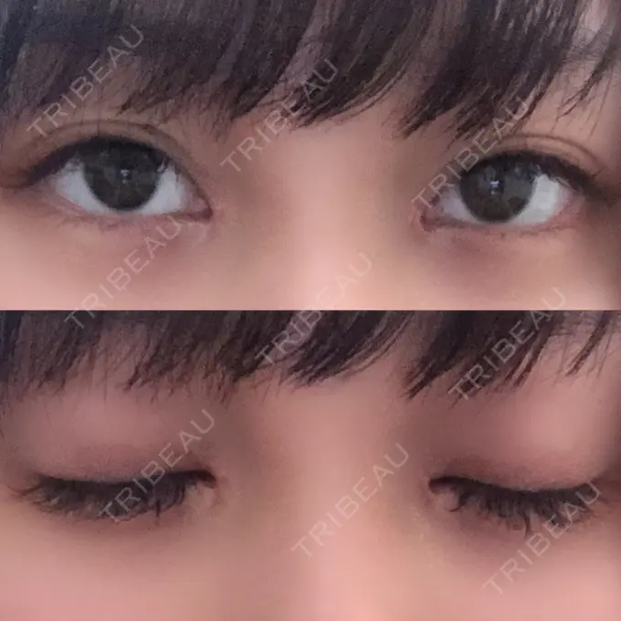 二重埋没 / 目頭切開 ドクター松井クリニック 新宿 DAY 23 メイン用