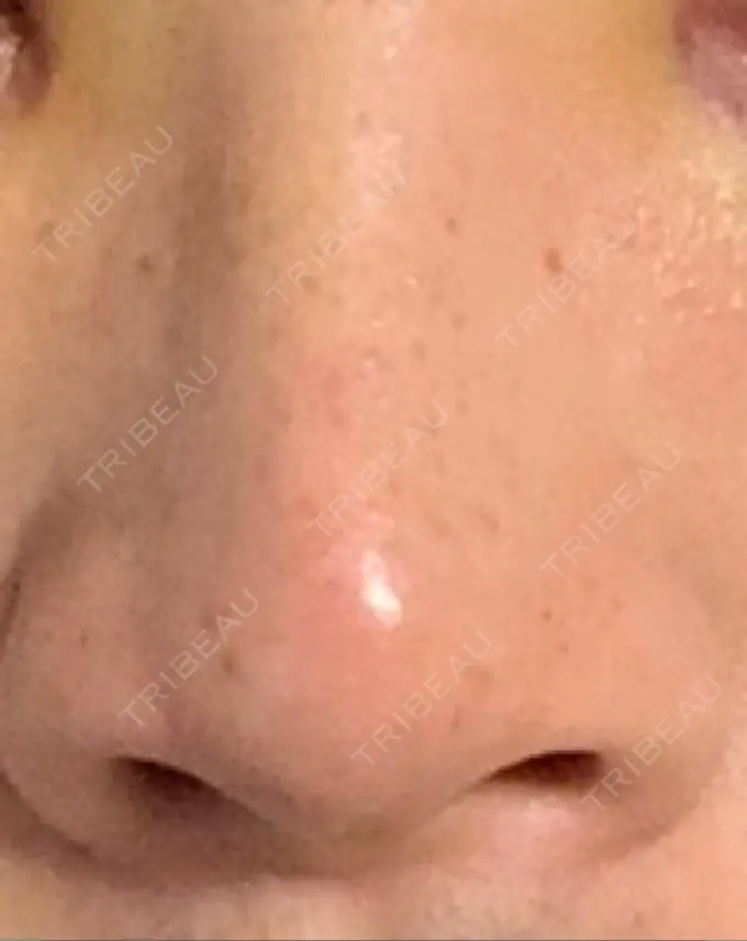 鼻尖形成（切開） / 軟骨移植 / レディエッセ注入（鼻） LETICIA CLINIC（レティシア クリニック） DAY 3 メイン用