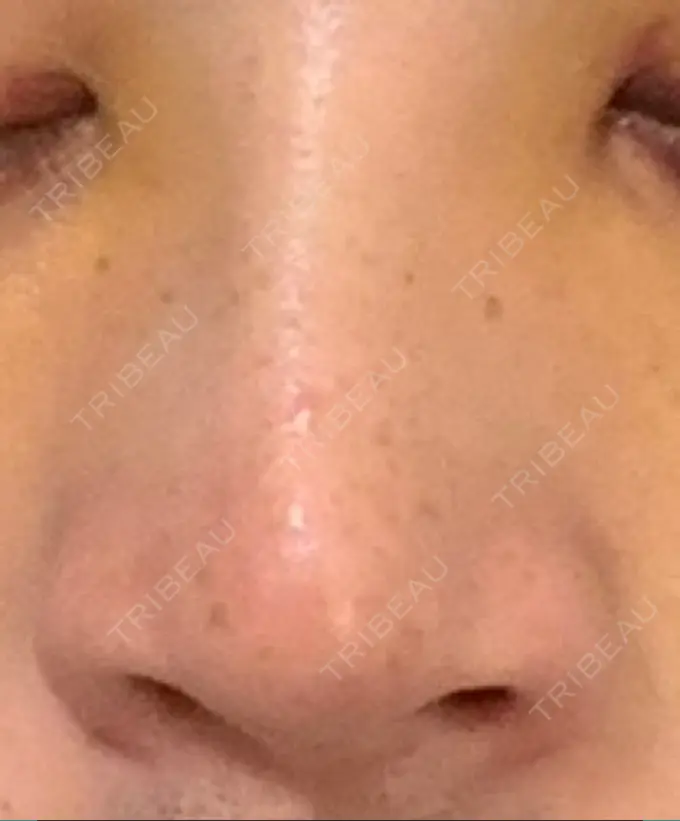 鼻尖形成（切開） / 軟骨移植 / レディエッセ注入（鼻） LETICIA CLINIC（レティシア クリニック） DAY 5 メイン用