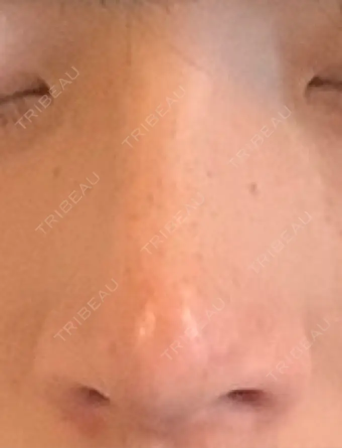 鼻尖形成（切開） / 軟骨移植 / レディエッセ注入（鼻） LETICIA CLINIC（レティシア クリニック） AFTER メイン用