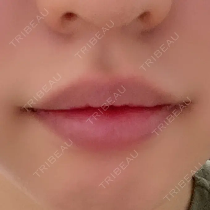 口角挙上 聖心美容クリニック 六本木院 DAY 3 メイン用