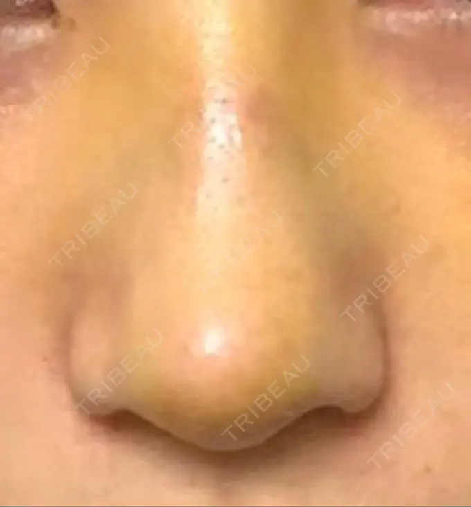 鼻尖形成（切開） / レディエッセ注入（鼻） LETICIA CLINIC（レティシア クリニック） DAY 5 メイン用