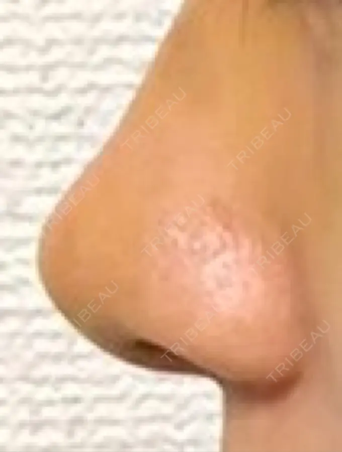 鼻尖形成（切開） / レディエッセ注入（鼻） LETICIA CLINIC（レティシア クリニック） DAY 5 メイン用