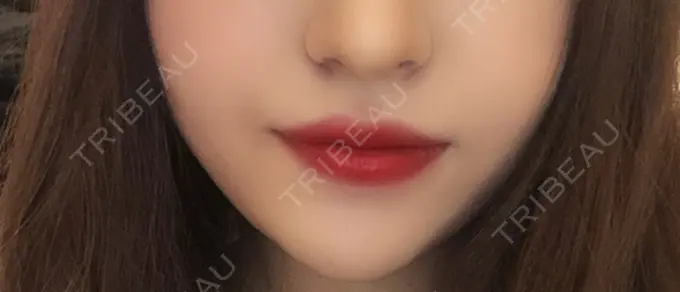 ヒアルロン酸注入（唇） / ボトックス（口角） TCB東京中央美容外科 堺院 AFTER メイン用