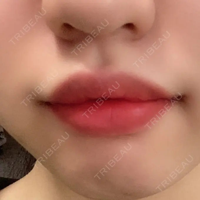 口角挙上 聖心美容クリニック 六本木院 DAY 4 メイン用