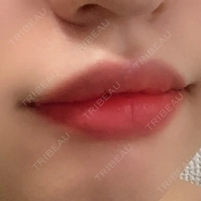 口角挙上 聖心美容クリニック 六本木院 DAY 4 メイン用