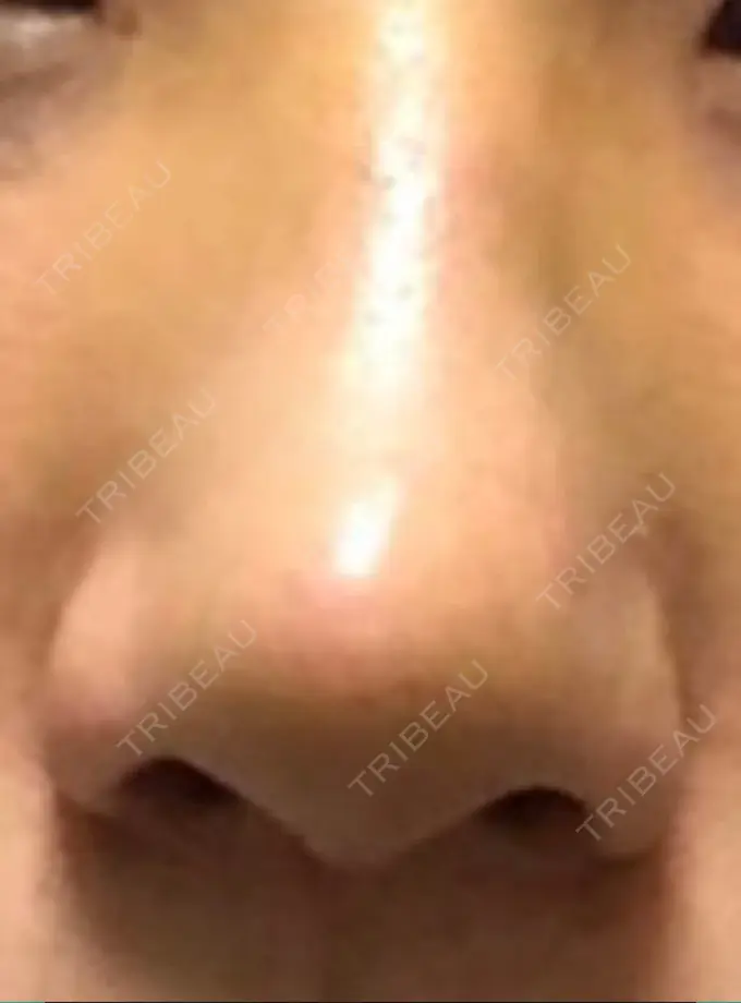 鼻尖形成（切開） / レディエッセ注入（鼻） LETICIA CLINIC（レティシア クリニック） DAY 7 メイン用