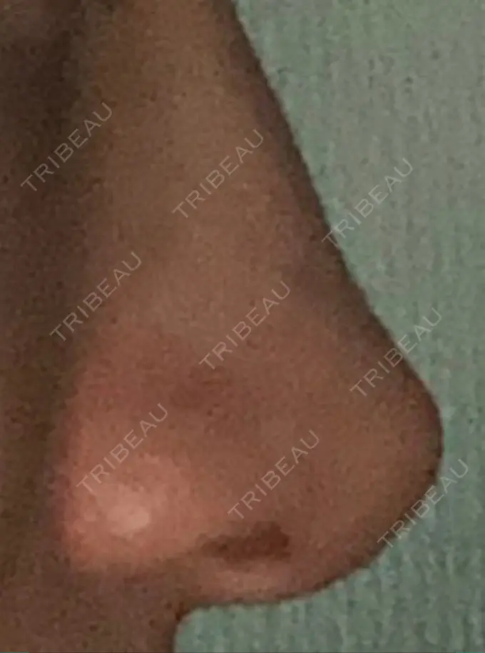 鼻尖形成（切開） / レディエッセ注入（鼻） LETICIA CLINIC（レティシア クリニック） DAY 30 メイン用