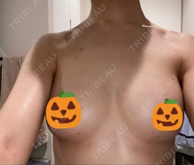 豊胸（ヒアルロン酸） WOM CLINIC GINZA （ワム クリニック ギンザ） AFTER メイン用