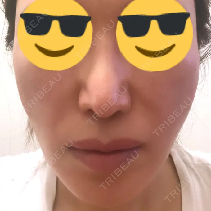 その他（目元） スノウ（Snow）整形外科 DAY 63 メイン用