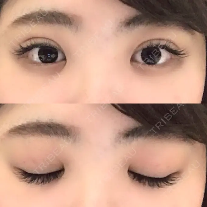 二重埋没 共立美容外科 柏院 DAY 1 メイン用