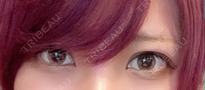 眼瞼下垂（切開） / 上まぶたの脂肪取り なでしこクリニック DAY 231 メイン用