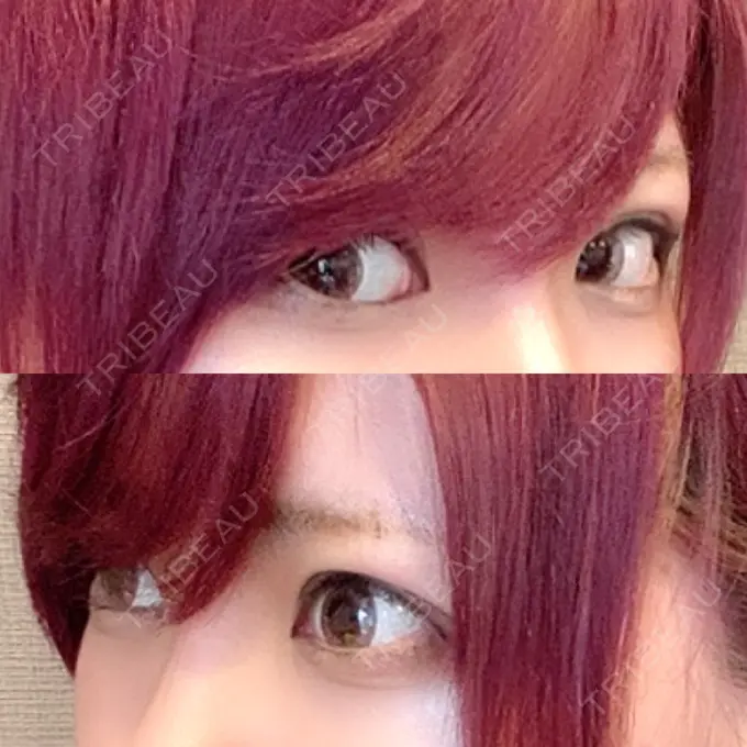 眼瞼下垂（切開） / 上まぶたの脂肪取り なでしこクリニック DAY 231 メイン用