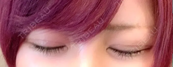 眼瞼下垂（切開） / 上まぶたの脂肪取り なでしこクリニック DAY 231 メイン用