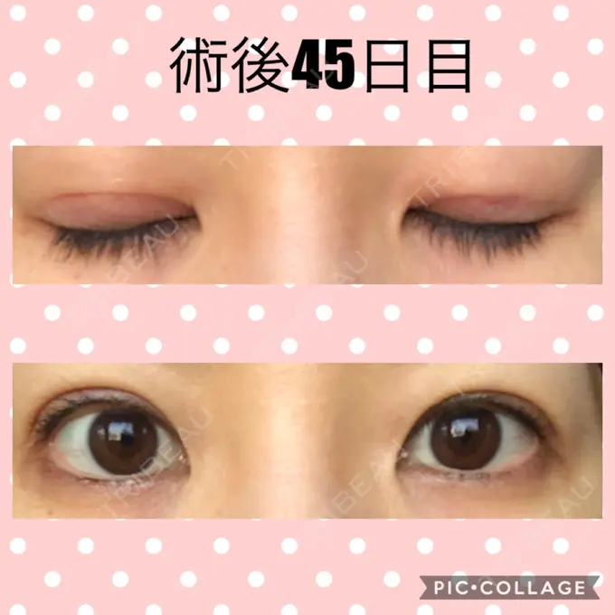 二重切開 マリアクリニック 安城院 DAY 45 メイン用